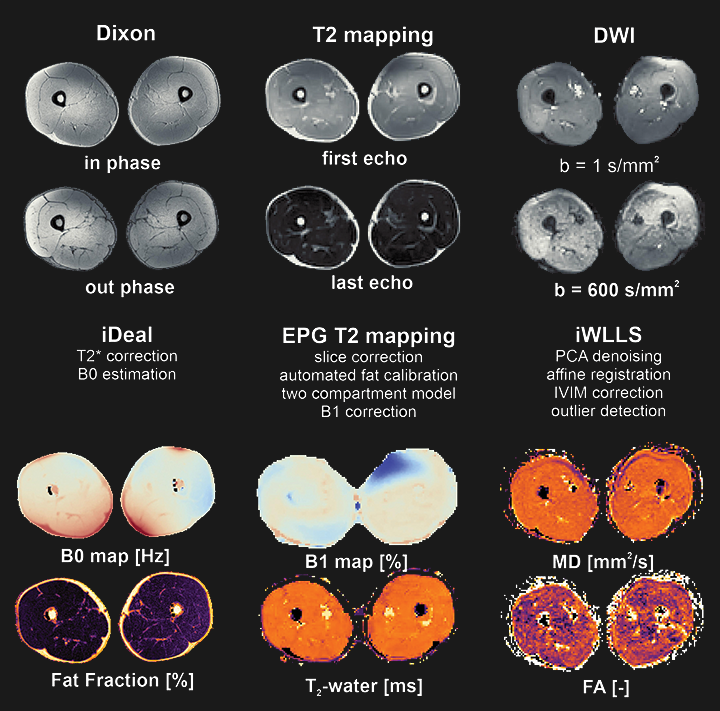 Quantitative muscle MRI processing of diffusion tensor imaging, T2 mapping and water fat chemical shift imaging.