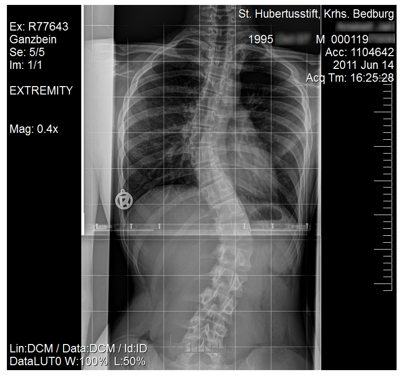Ensemble-Deep-Learning-to-Classify-Scoliosis-and-Healthy-Subjects