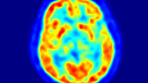 A picture of a PET scan of a brain with red, blue and green.
